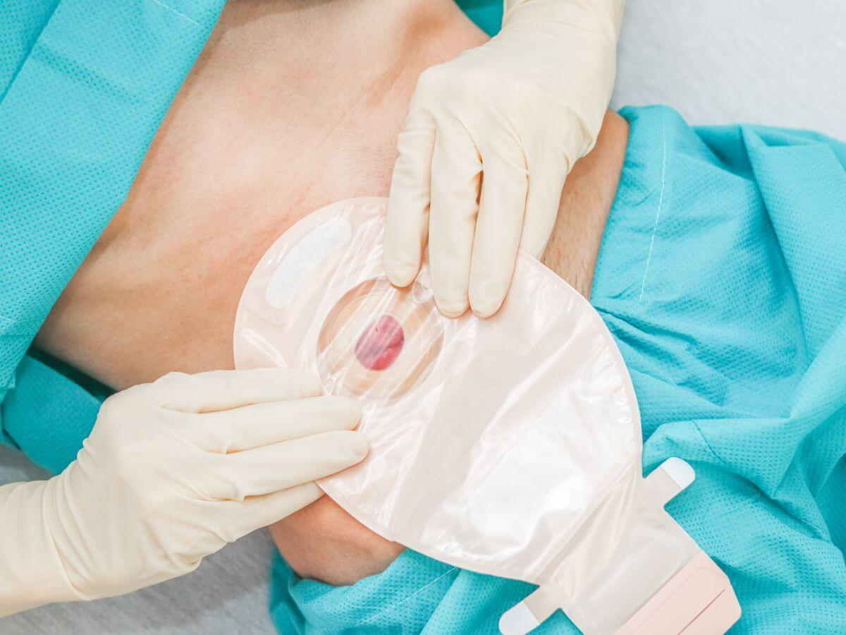 What is an Ostomy?