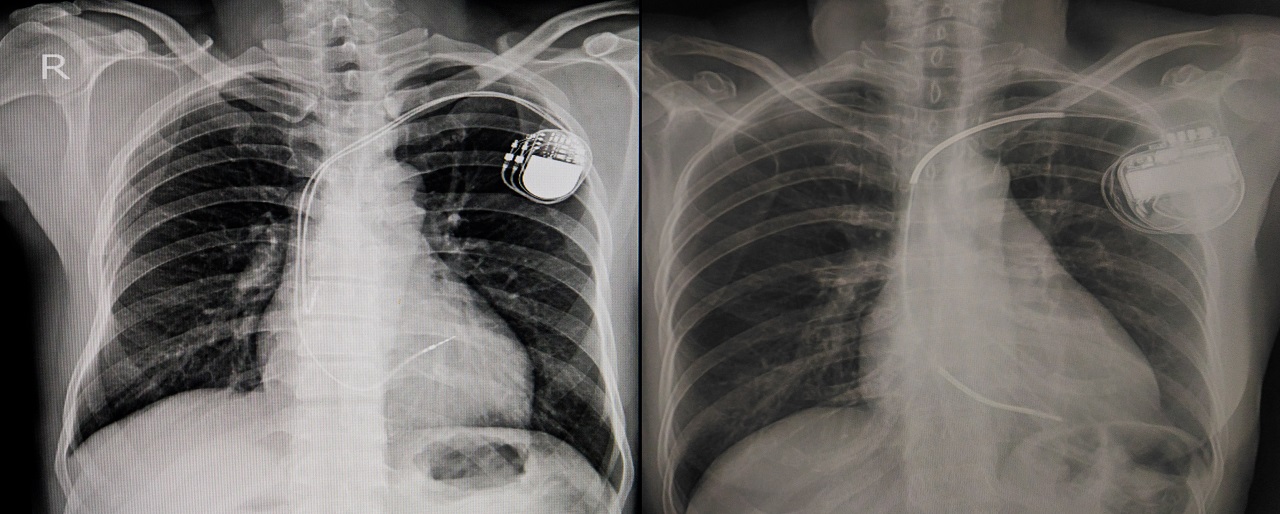 X-ray revealing placement of permanent pacemaker