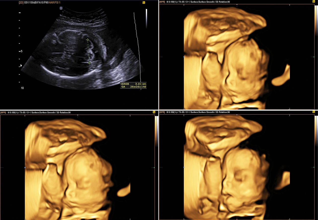4D ultrasound imaging