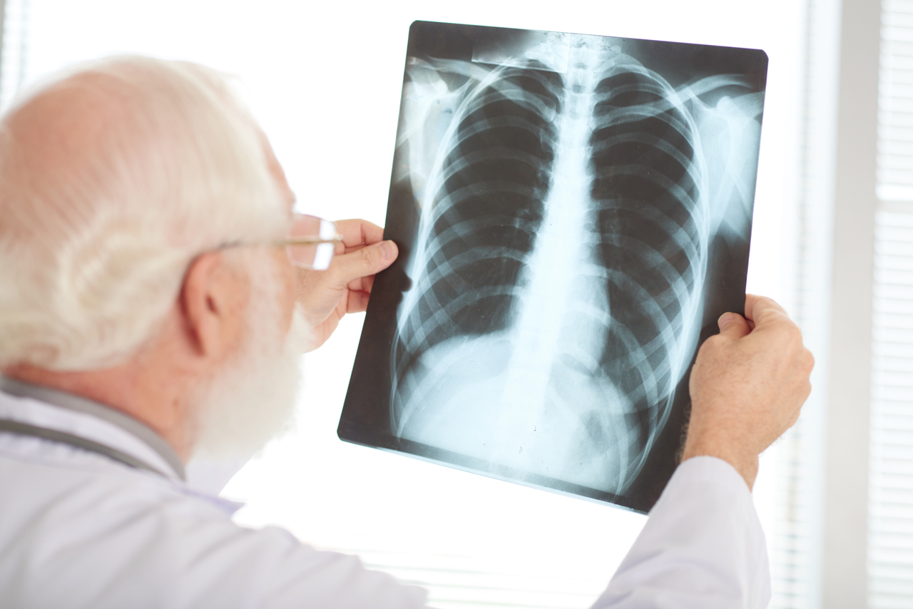 A doctor looking at a chest x-ray of pneumonia patient