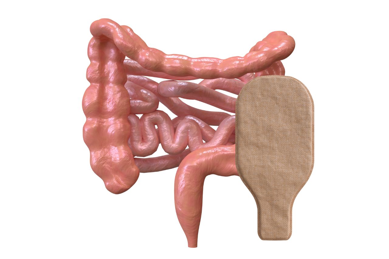Intestine with colostomy bag